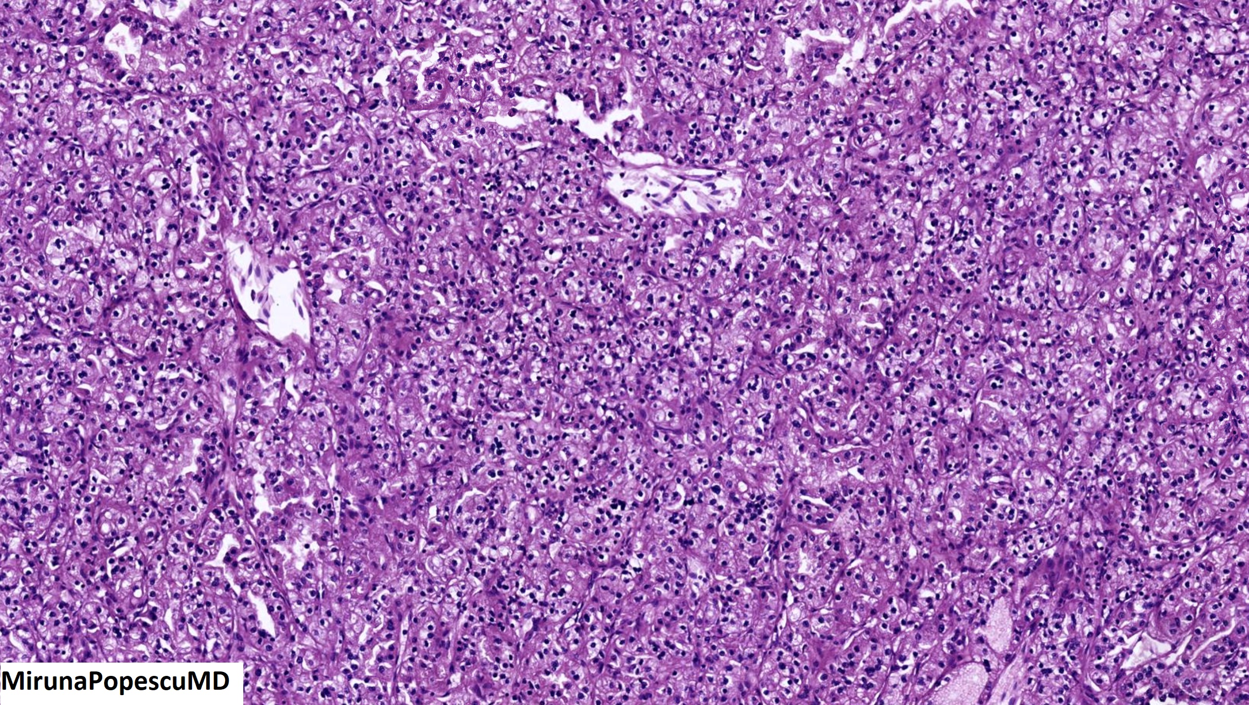 Clear Cell Renal Cell Carcinoma With Rhabdoid And Sarcomatoid Features 